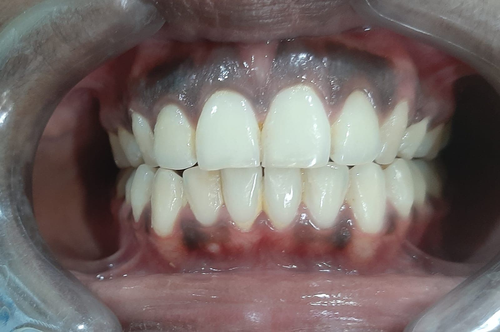 Bite & Gap Correction — after treatment
