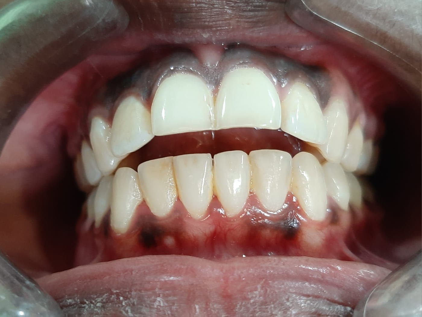Bite & Gap Correction — before treatment