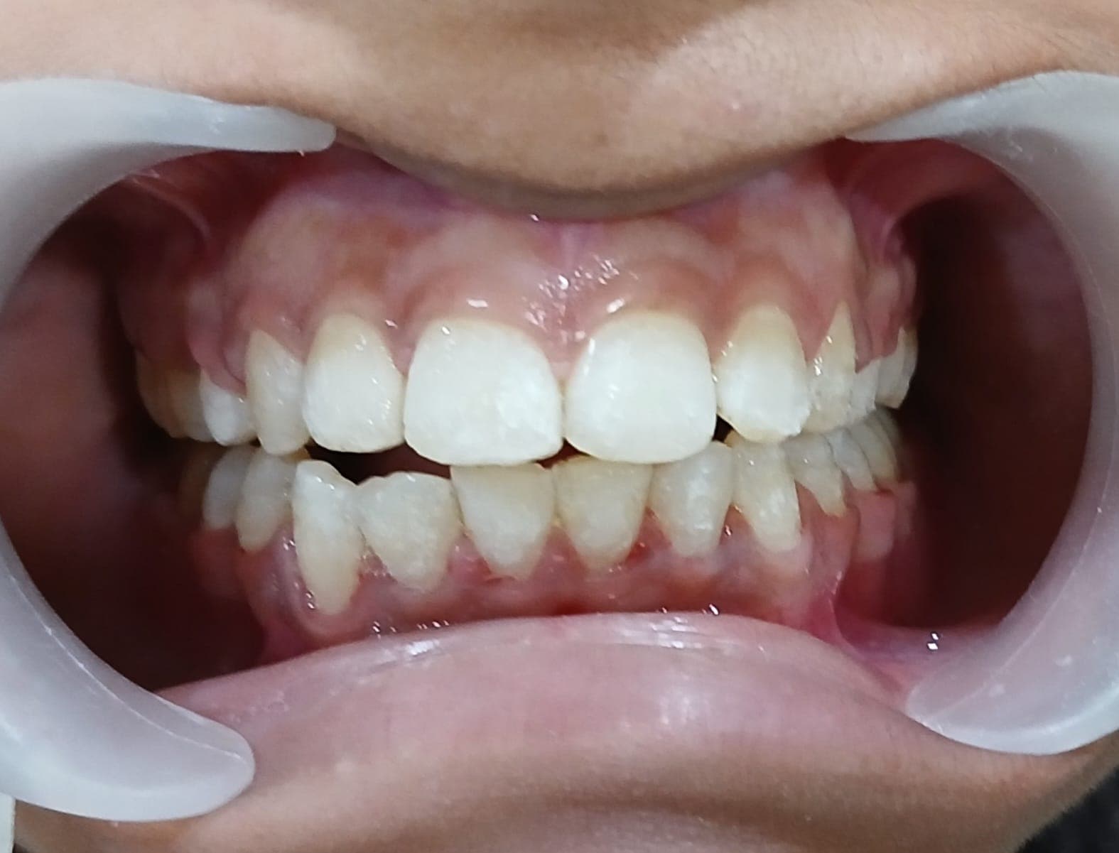 Crowded Teeth Alignment — after treatment