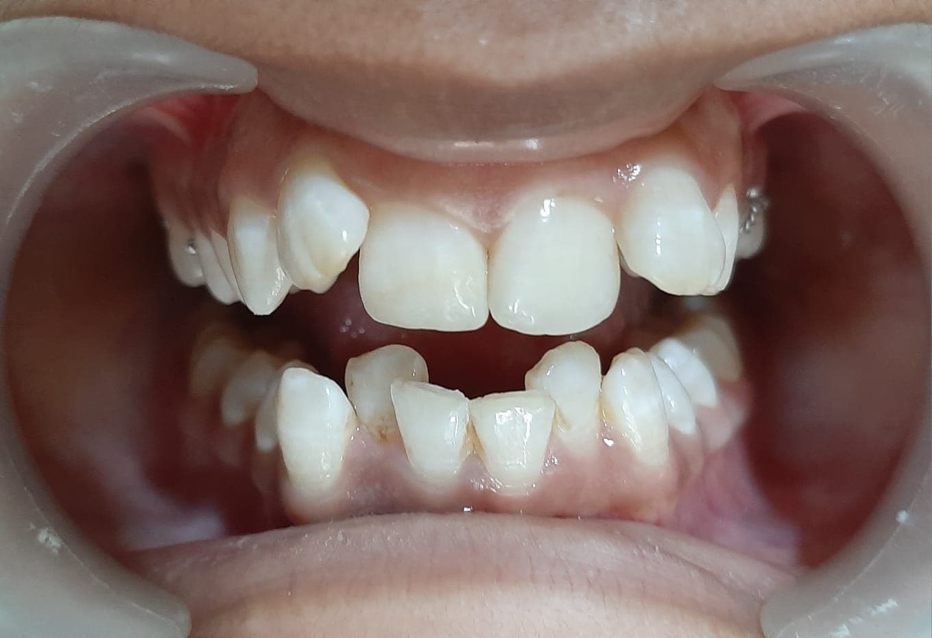 Crowded Teeth Alignment — before treatment